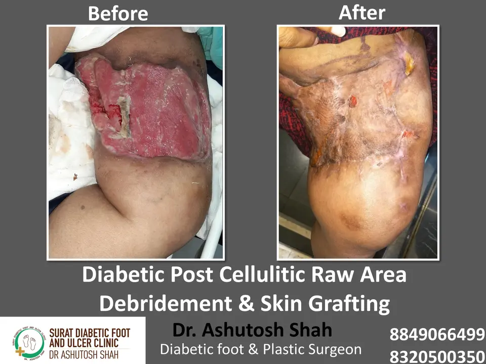 Diabetic Cellulitis and Coverage.pptx-19.webp